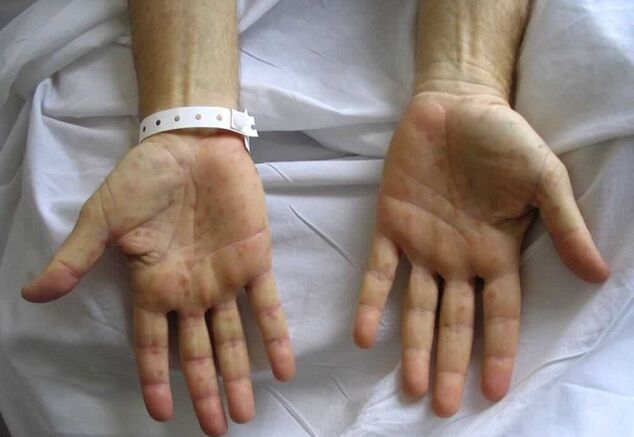 syphilis in the hands as a cause of pathological discharge from the penis
